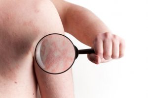 Treat psoriasis with home remedies