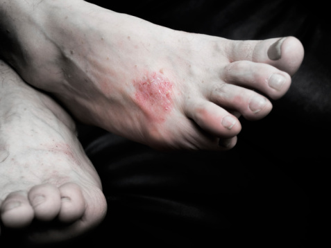 Psoriasis linked to type 2 diabe...