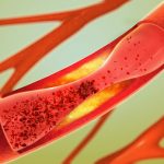 Rheumatoid arthritis increases deep vein thrombosis risk