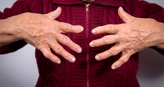 Rheumatoid arthritis raises risk...