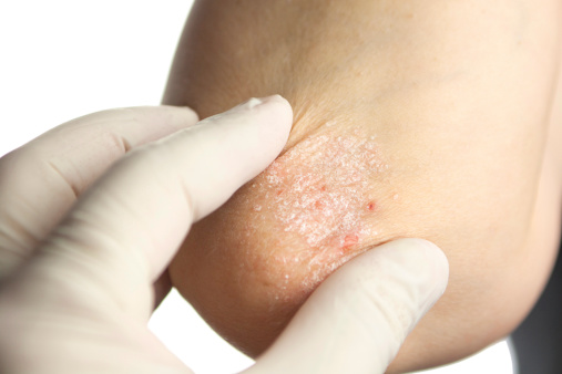 Risk of aneurysm in the abdomen ...