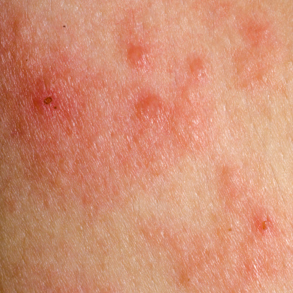 Pityriasis rosea different stage...