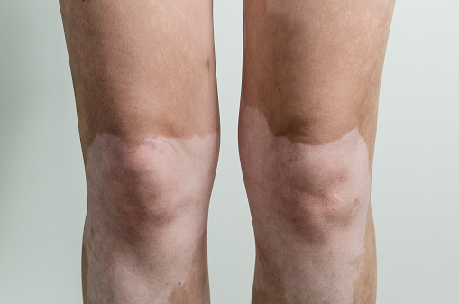 Vitiligo and the increased risk ...