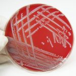 Lupus risk associated with chronic exposure to staph staphylococcus aureus bacteria