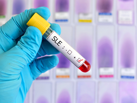 In lupus patients, anti-inflamma...