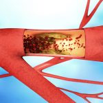 Celiac disease patients may face higher coronary artery disease risk