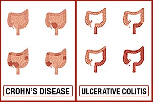 Crohn's disease vs ulcerative colitis