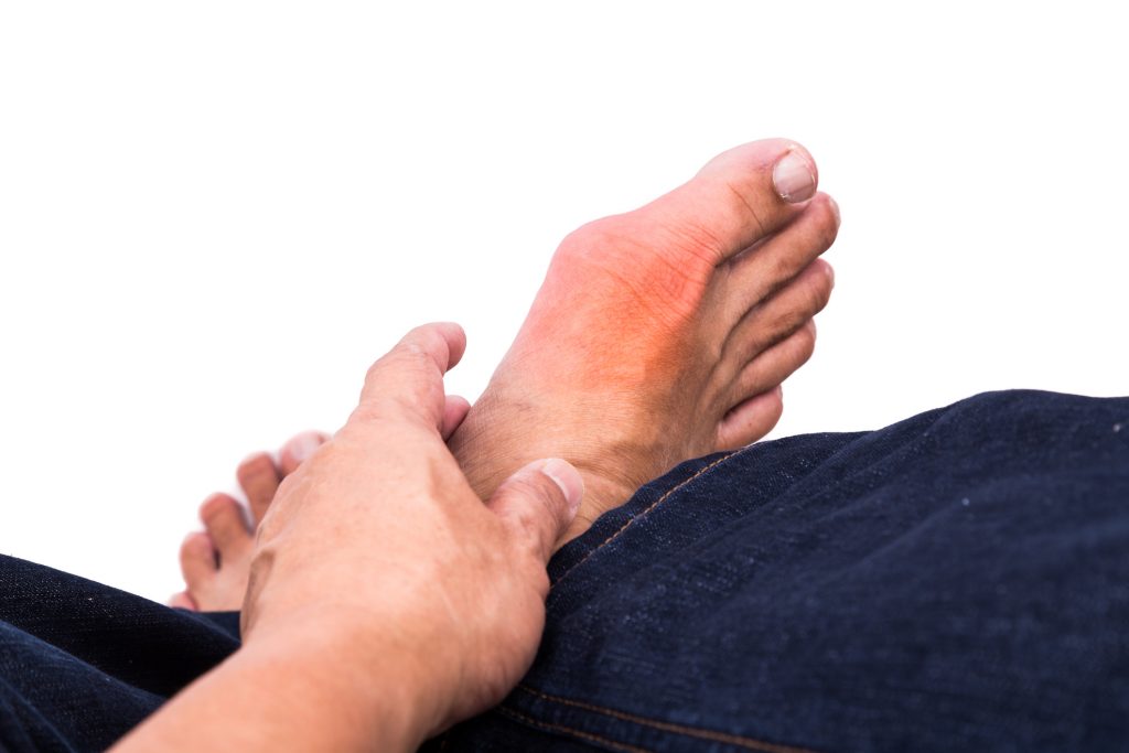 Gout treatment safe with oral steroids or nonsteroidal anti