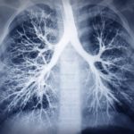 lupus-affects-the-lungs