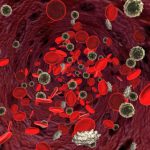 lupus patients face anemia risk from inflammation iron deficiency renal insufficiency