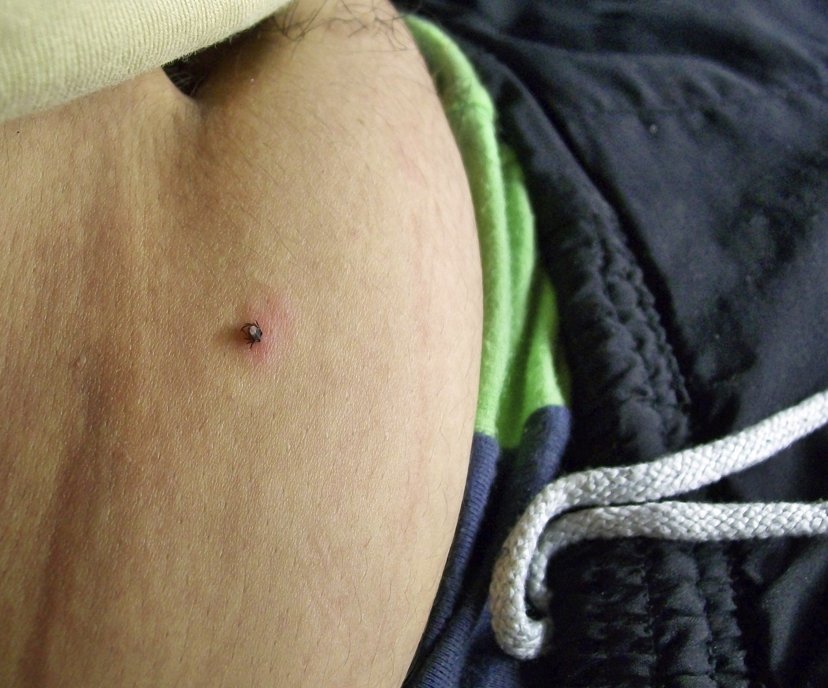 Lyme disease and autism associat...