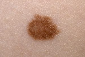 Melanoma survival boosted with new drug