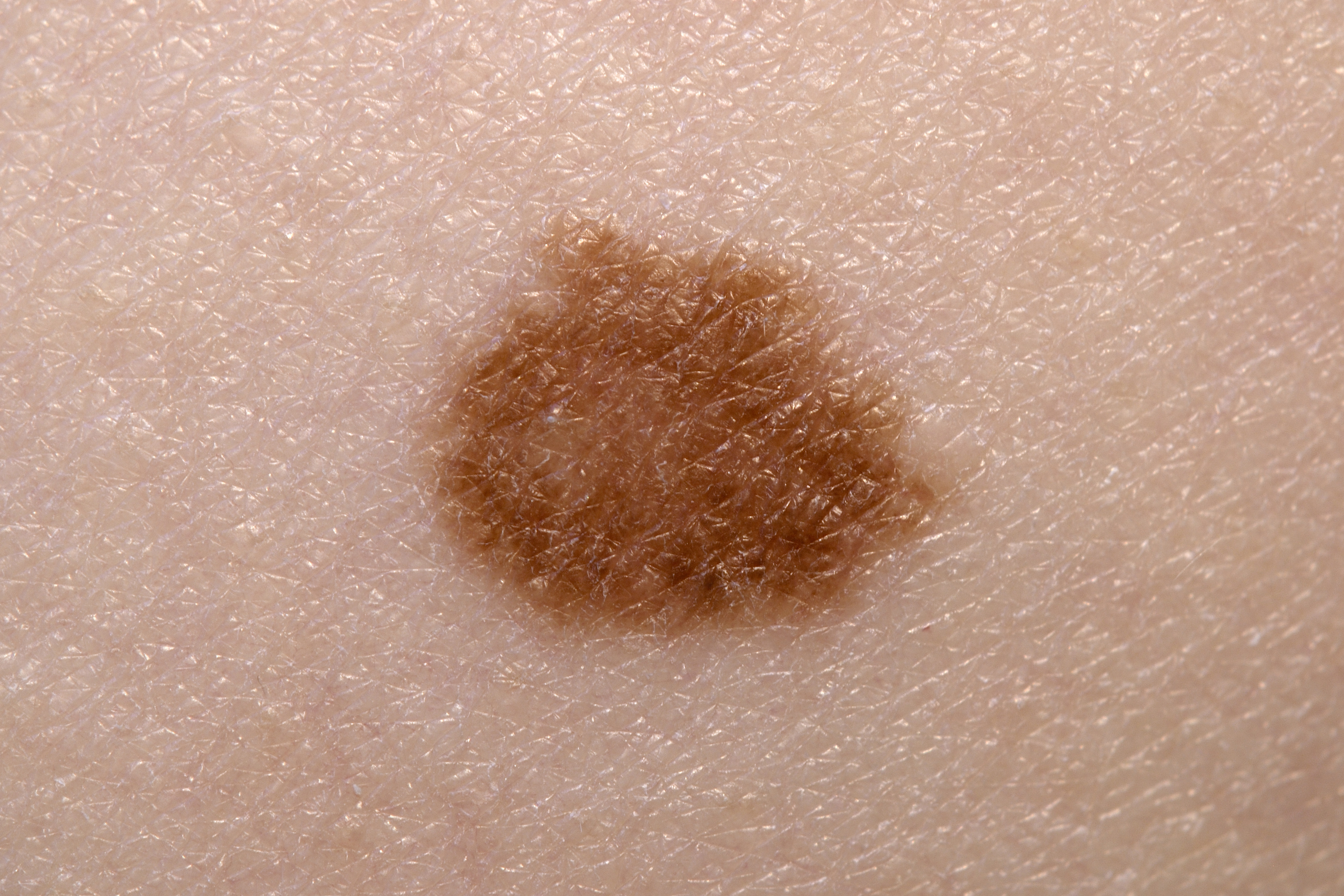 Melanoma survival boosted with n...