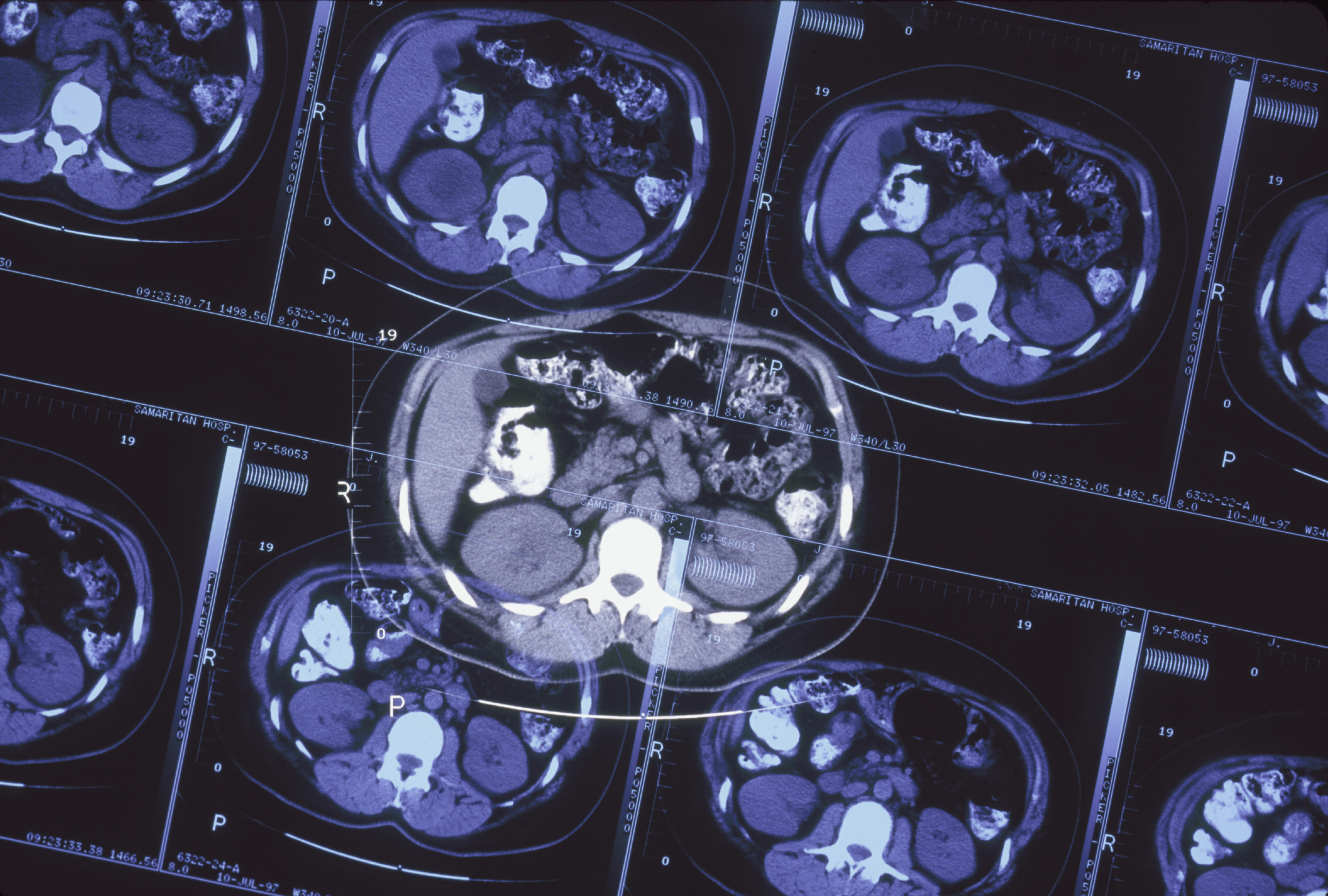 Multiple sclerosis treatment for...