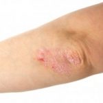 Psoriasis risk increases with high blood pressure and anti-hypertension drugs, study