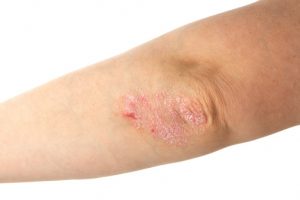 Psoriasis risk increases with high blood pressure 
