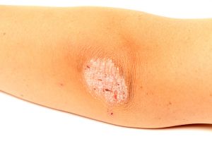Psoriasis patients requiring biologic treatments face economic and racial barriers, study