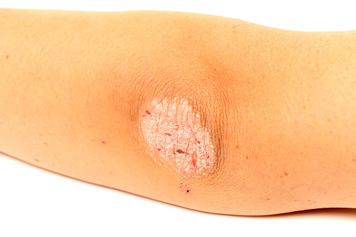 Psoriasis patients requiring bio...