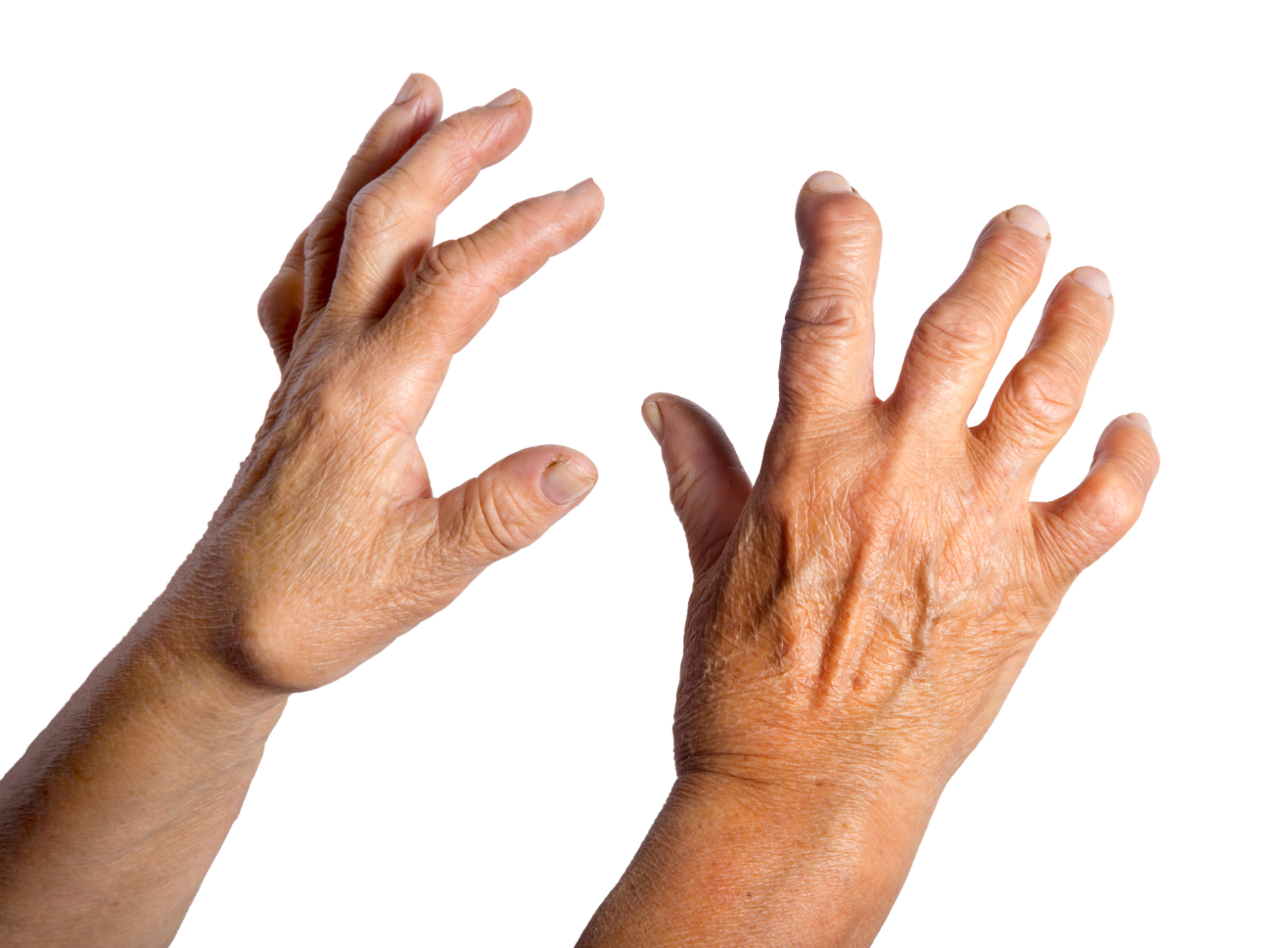 Rheumatoid arthritis risk may de...