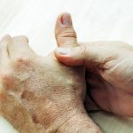 Rheumatoid arthritis vs. osteoarthritis, differences in symptoms, causes, and treatment