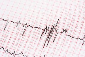 Risk of irregular heartbeat affected by race