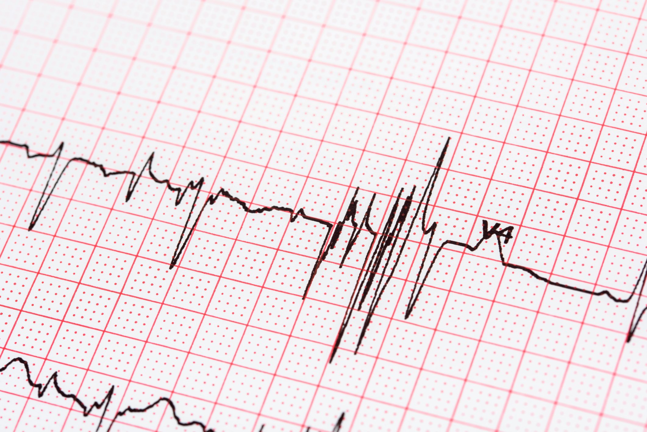 Risk of irregular heartbeat affe...