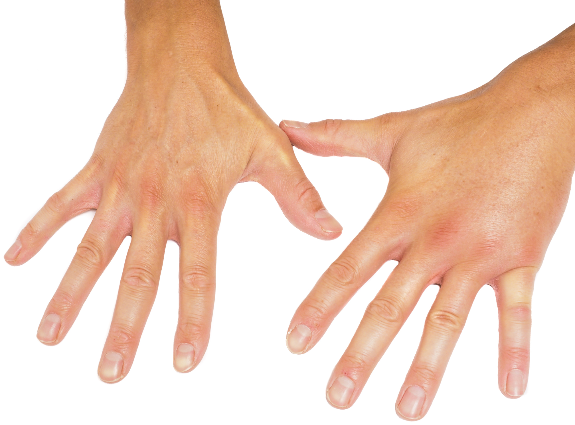 Swollen hands in the morning: Ca...