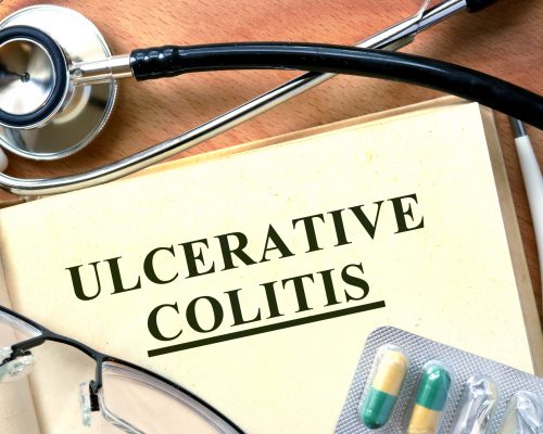 Ulcerative colitis flare up