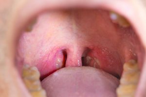 white spots on tonsils in the mouth