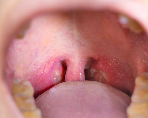 Strep white throat patches when disappear from will the White Spot