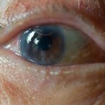 1prevent-cataracts-naturally-home-remedies-300x200