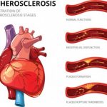1systemic-atherosclerosis-scleroderma-independent-risk-factor-300x258