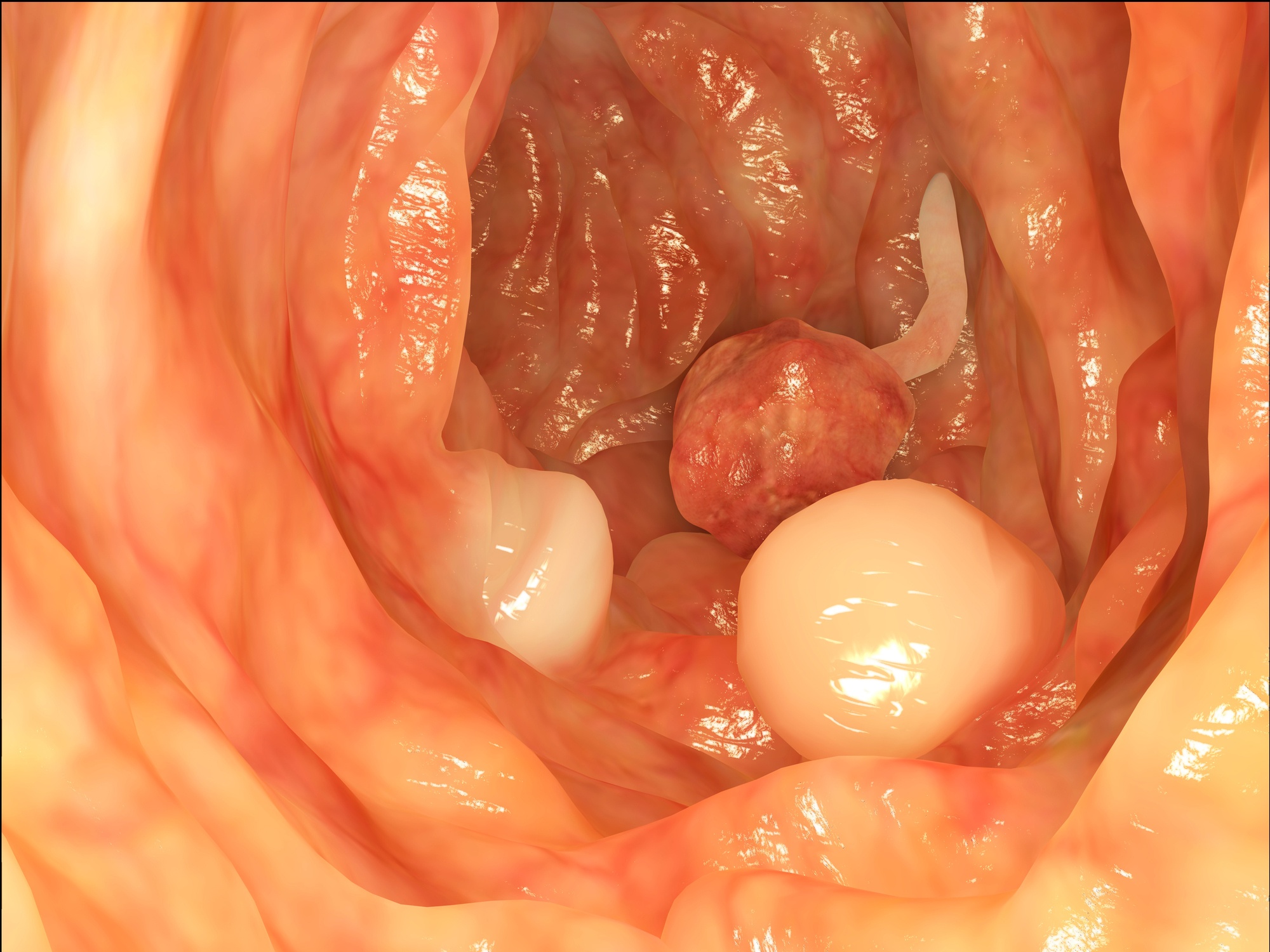 Colon cancer screening should be...