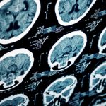 Hypertension drug blocks traumatic brain injury