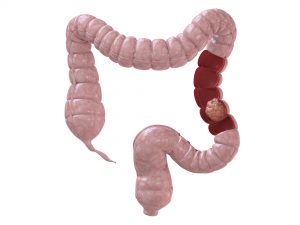 Inflammatory bowel disease related colon cancer risk lowered with vitamin D: Study 