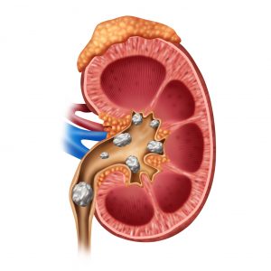 Kidney stone treatment complications common in 14 percent of patients, costs raising: Study