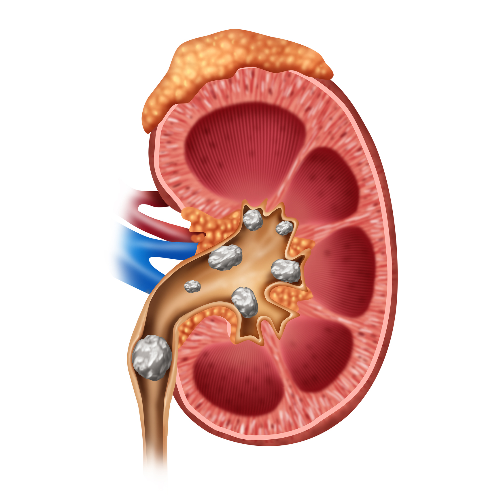 Kidney stone treatment complicat...