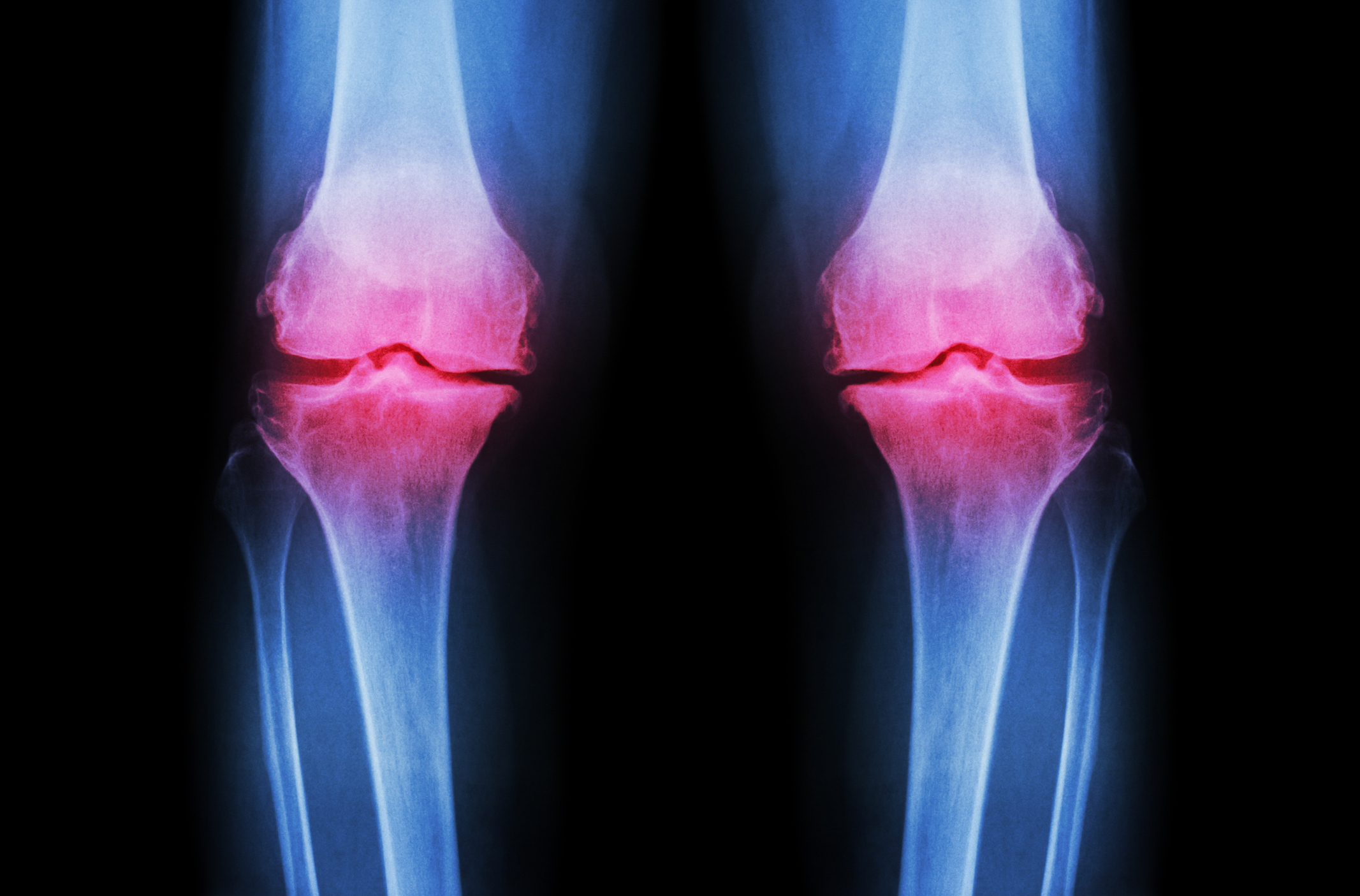 Osteoarthritis severity same as ...