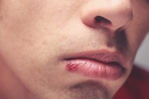 Psoriasis and cold sores, the most stigmatized skin disorders: Study
