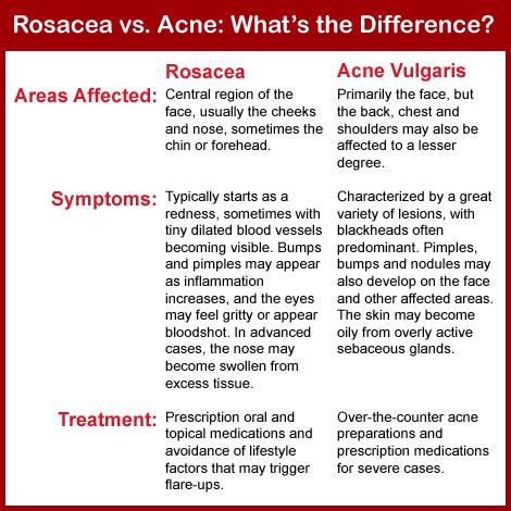 Comparing Rosacea and Acne: Signs and symptoms