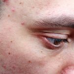 Rosacea vs. acne: Differences in symptoms, causes, and treatment