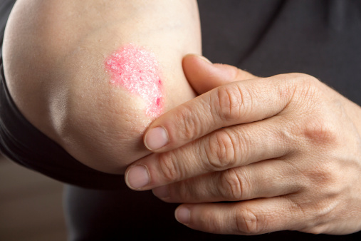 Severe psoriasis can be complete...