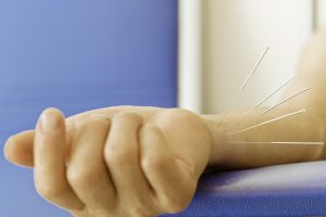 Carpal tunnel syndrome (CTS) eased with electroacupuncture
