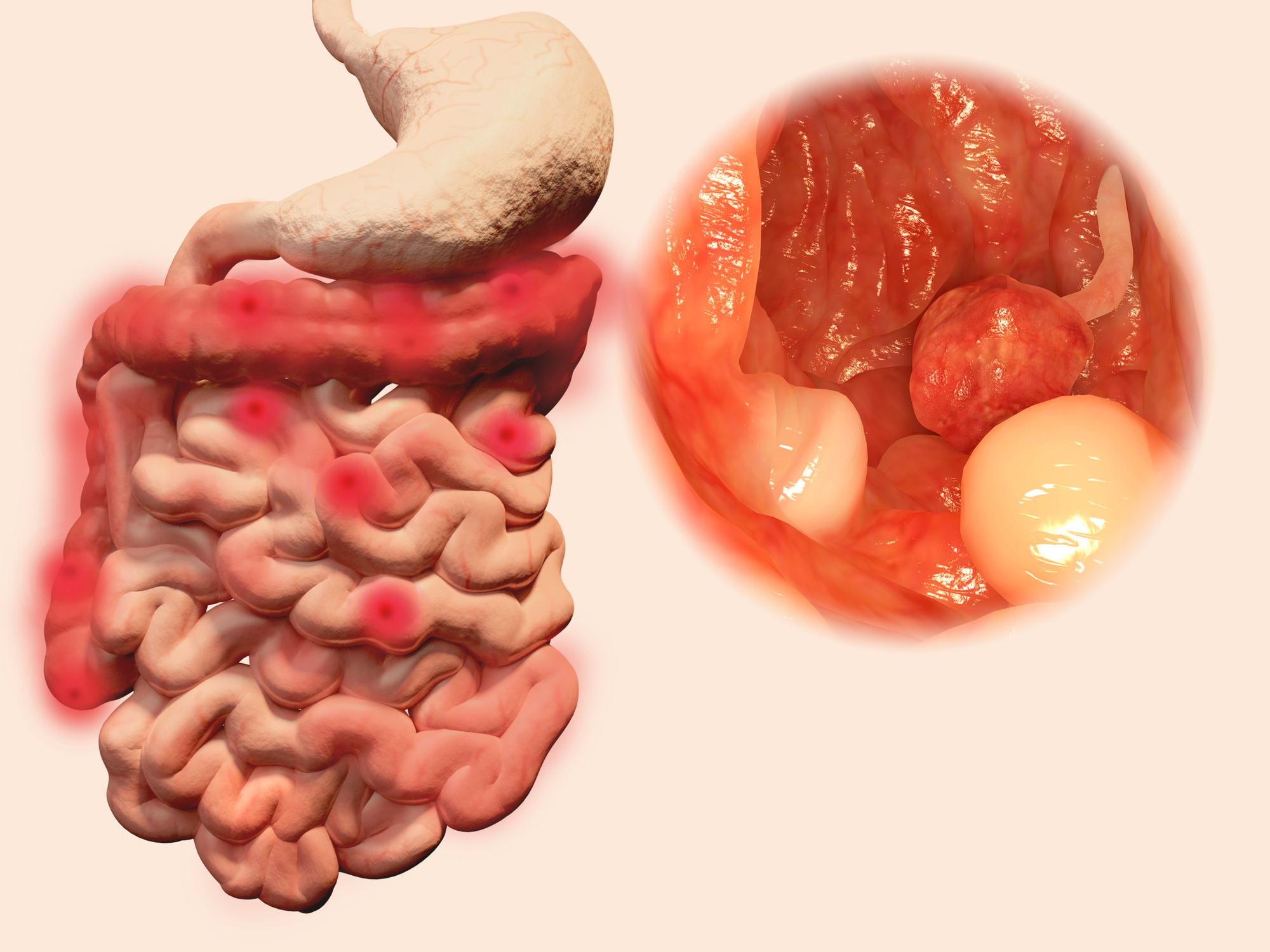 Crohn’s disease, ulcerative coli...