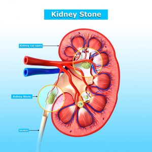 Kidney stones linked to increased risk of kidney problems later in life: Study