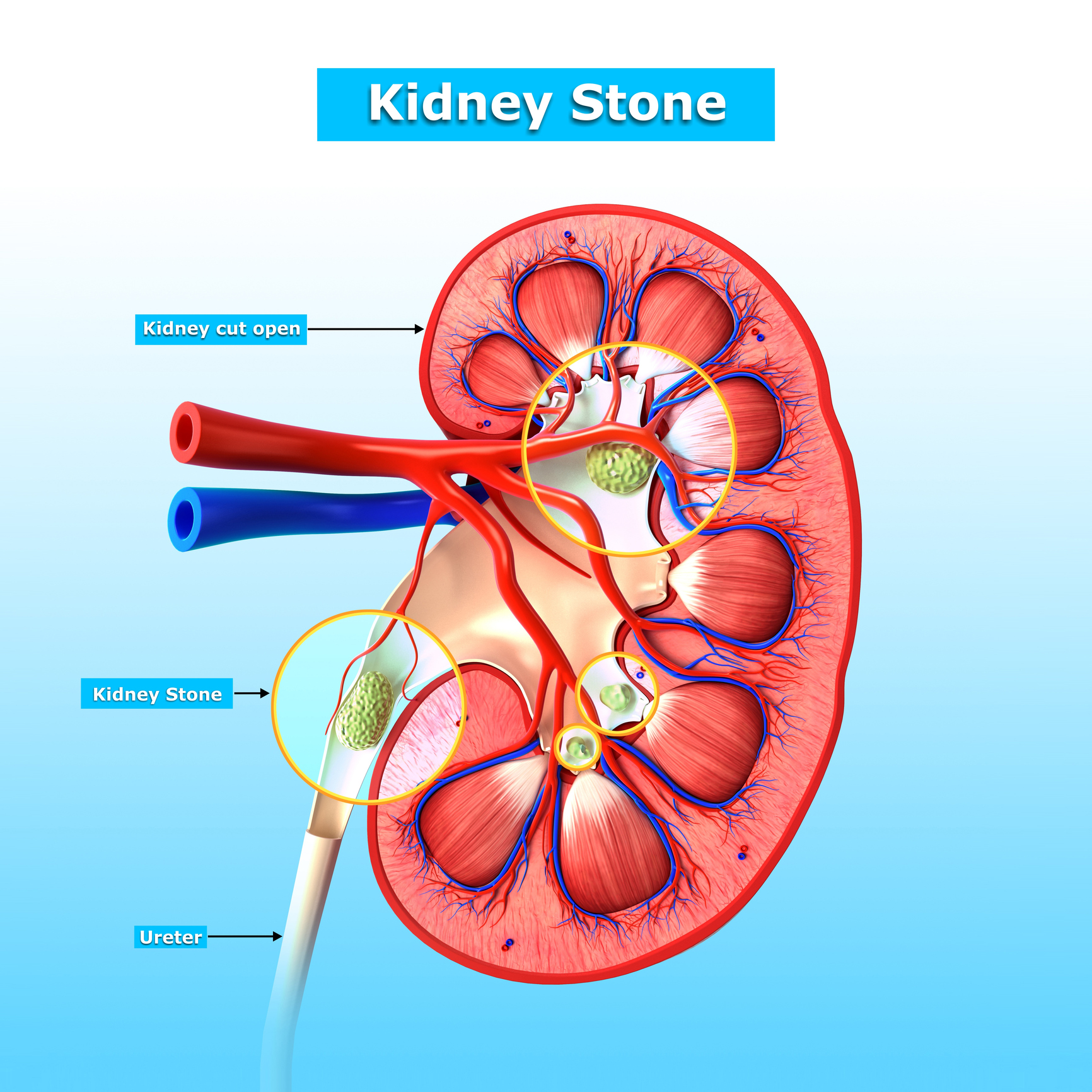 Kidney stones linked to increase...