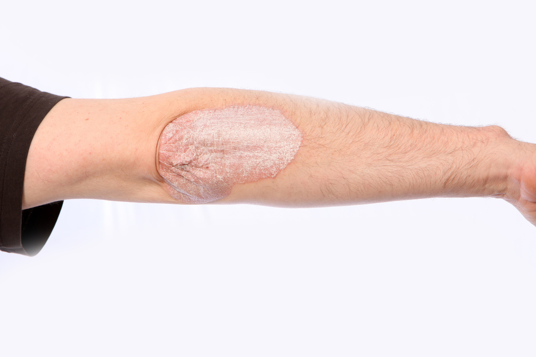 New psoriasis drug found to work...