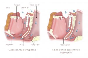 Obstructive sleep apnea risk increases with asthma: Study