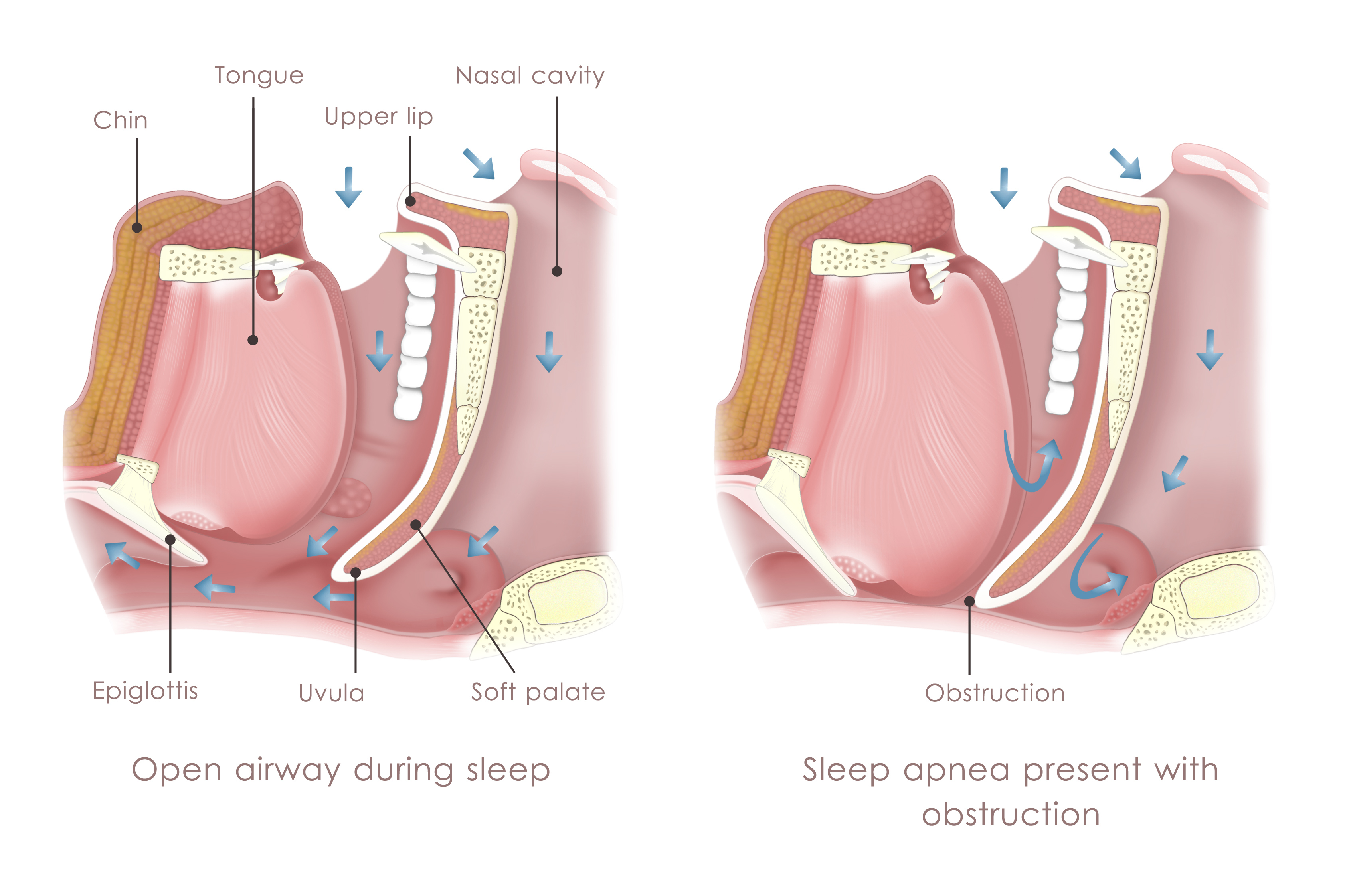 Obstructive sleep apnea risk inc...
