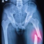 Osteoporosis medications can cause small risk of thigh bone fractures: Study